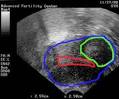 Fibroid Tumors In The Uterus, Fertility and Infertility