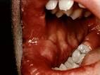 HIV and AIDS