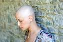 they are bald woman