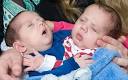 Conjoined twins Azzedine and