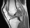 Bone Bruise Sign