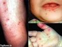 Hand Foot and Mouth Disease Pictures, Symptoms, Causes and Treatment