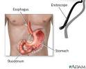 Gastric endoscopy