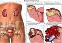 ECTOPIC PREGNANCY SYMPTOMS >> When do pregnancy symptoms start ...