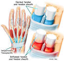 What is <b>de Quervain's disease</b>?
