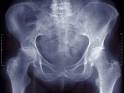 Discovery Health "Hip Dysplasia Diagnosis in Adults"