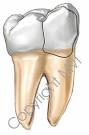 Cuspal <b>Fracture</b>, Cracked <b>Tooth</b>