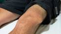 <b>Patellar</b> Subluxation and