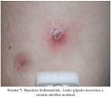 <b>Transtornos Linfoproliferativos</b> (Síndrome <b>Linfoproliferativa</b> Ligada ao X;