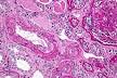 Antiphospholipid syndrome - Wikipedia, the free encyclopedia