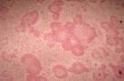 Hives Picture (Hardin MD Super Site Sample)