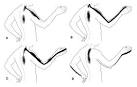 <b>Radiculopathy</b>