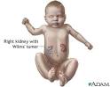 Wilms tumor: MedlinePlus Medical Encyclopedia Image