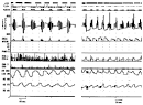 Sleep related breathing disorders in adults with Down syndrome