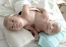 Personas Deformes Reales
