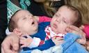 Hassan and Hussein Benhaffaf, the conjoined twin boys. - Hassan-and-Hussein-Benhaf-001