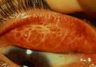 propagación del <b>tracoma</b>.