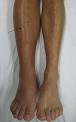 Deep vein thrombosis - Wikipedia, the free encyclopedia