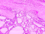 in <b>follicular carcinoma</b>