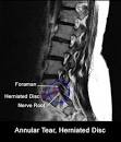 becoming a herniated disc