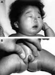 the hypertrophied clitoris