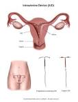 Summit Medical Group - Intrauterine Device (