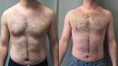 File:<b>Gynecomastia</b> with
