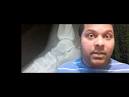 Fibular Fractures: Causes