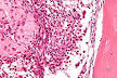 of a <b>chondroblastoma</b>.