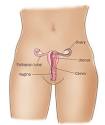 Ovarian Cysts Ovarian Cyst Ovarian Cyst Symptoms Ovarian Cyst ...