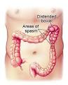 Irritable bowel syndrome - Pharmacy and Drugs