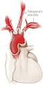<b>Takayasu's Arteritis</b>