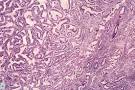 <b>Hiperplasia endometrial</b>