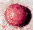 Histiocytoma (dog) - Wikipedia, the free encyclopedia