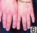  Stop The Expansion Of Candida By Starving The Fungus.
