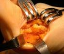 Il problema dell'<b>alluce</b> valgo