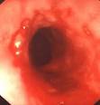 Natural Cure for Acid Reflux Disease, Heartburn and Gastritis ...