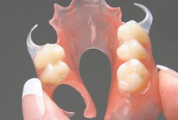 The Right Retention Method For Your Flexible Partial Denture
