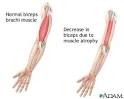 Image for <b>atrophy</b>