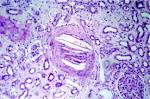 <b>embolism</b>, <b>cholesterol</b> : KMLE
