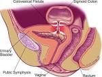 a sigmoid-<b>vaginal fistula</b>.