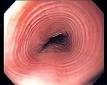 Eosinophilic esophagitis - Wikipedia, the free encyclopedia