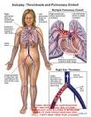 Thrombosis and Pulmonary Emboli