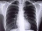 Bronchial Diseases