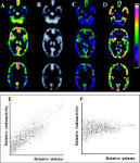  Correction for Partial-Volume Effects on Brain Perfusion SPECT in ... 