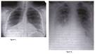<b>pneumonie</b> à <b>pneumocoques</b>