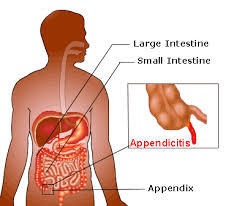 appendicitis