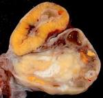 File:Human <b>Ovary</b> with Fully