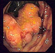 Crohn's disease - Wikipedia, the free encyclopedia