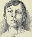 26 <b>Paralysis</b> of the facial